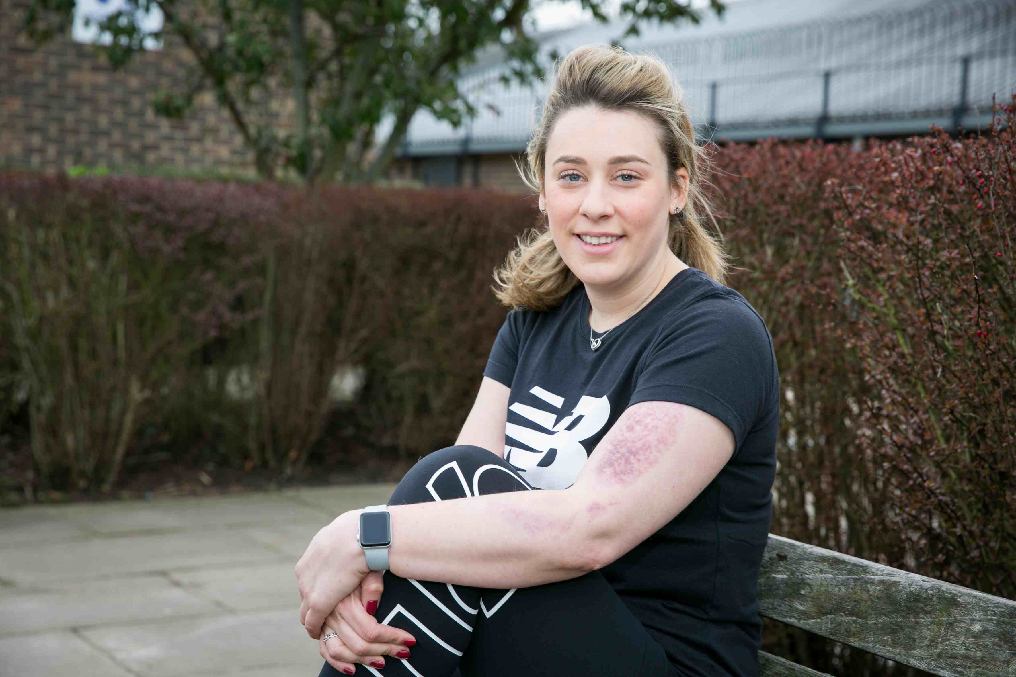 Police officer who fell into barbecue to run marathon for burns victims kate-riley-008-copy